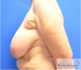 Breast Reduction