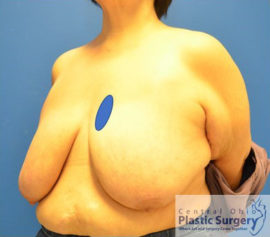 Breast Reduction/Breast Lift
