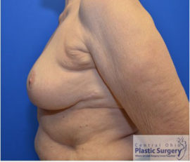 Breast Reduction/Breast Lift