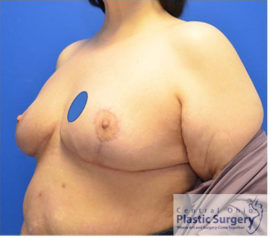 Breast Reduction/Breast Lift