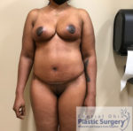 Breast Reduction/Breast Lift