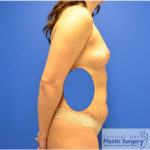 Breast Augmentation