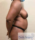 Breast Reduction/Breast Lift
