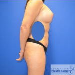 Breast Augmentation