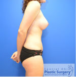 Breast Augmentation with Lift