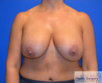 Breast Implant Removal