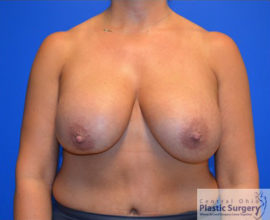 Breast Implant Removal