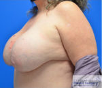 Breast Implant Removal