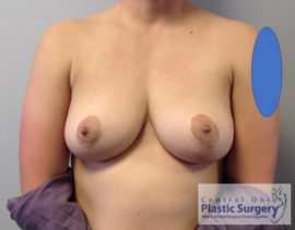 Breast Implant Removal