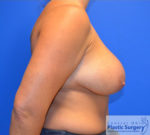 Breast Implant Removal