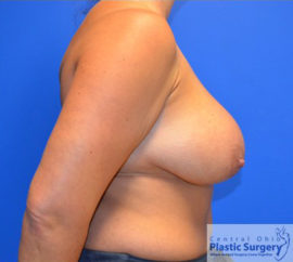 Breast Implant Removal