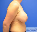 Breast Implant Removal