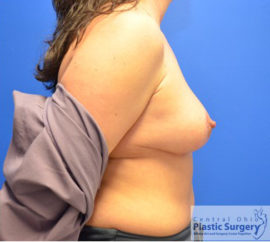 Breast Implant Removal