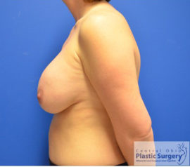 Breast Implant Removal