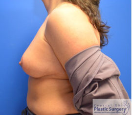 Breast Implant Removal