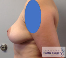 Breast Implant Removal