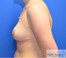 Breast Implant Removal