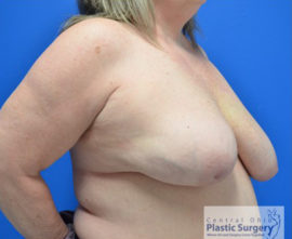 Breast Implant Removal