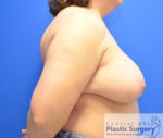 Breast Reconstruction