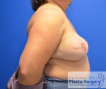 Breast Reconstruction