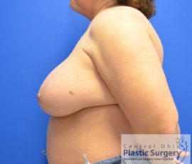 Breast Reconstruction