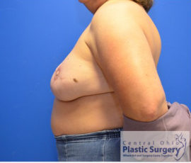 Breast Reconstruction