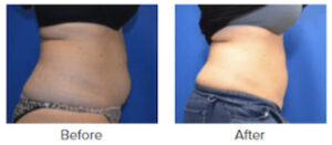 Before and After CoolSculpting Patient