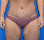 Tummy Tuck