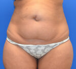 Tummy Tuck