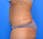 Tummy Tuck