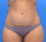 Tummy Tuck