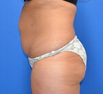 Tummy Tuck