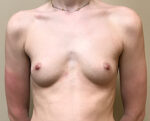 Breast Augmentation