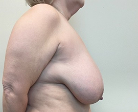 Breast Reduction/Breast Lift