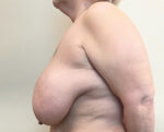 Breast Reduction/Breast Lift