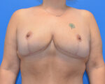 Breast Reduction/Breast Lift