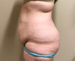 Tummy Tuck