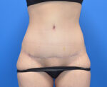 Tummy Tuck