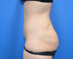Tummy Tuck