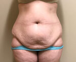 Tummy Tuck