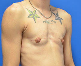 Gender Confirmation Top Surgery