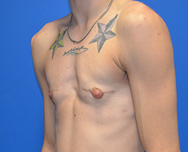 Gender Confirmation Top Surgery