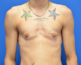 Gender Confirmation Top Surgery