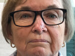 Skin Cancer Reconstruction