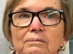 Skin Cancer Reconstruction