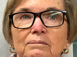 Skin Cancer Reconstruction