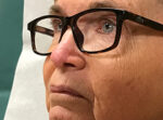 Skin Cancer Reconstruction
