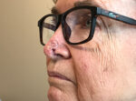 Skin Cancer Reconstruction