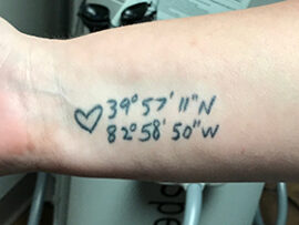 Tattoo Removal