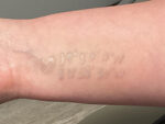 Tattoo Removal